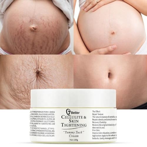 Stretch Marks and Scars Removal Cream for Pregnancy – Scars Repair, Abdominal Firming, and Gentle Stretch Marks Eradication Skincare Body